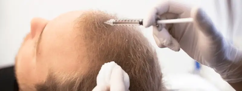 نتائج زراعة الشعر في دبي أفضل بكثير من النتائج في تركيا