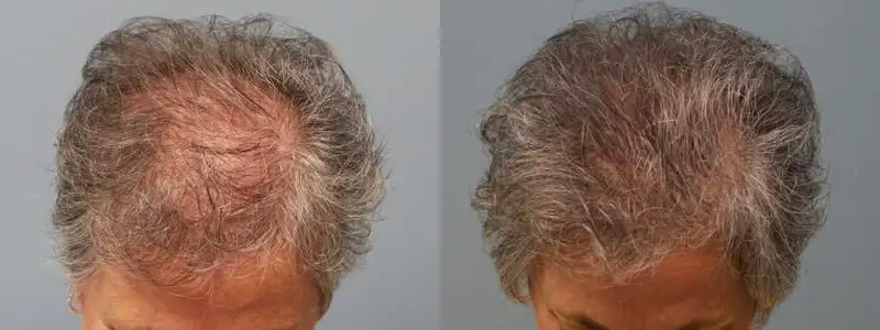 علاج أخطاء عمليات زراعة الشعر القديمة أصبح ممكنًا