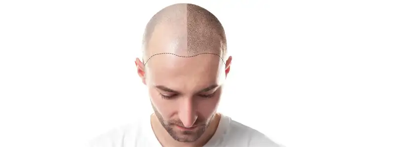 تقنية جديدة لزراعة الشعر بالبلازما