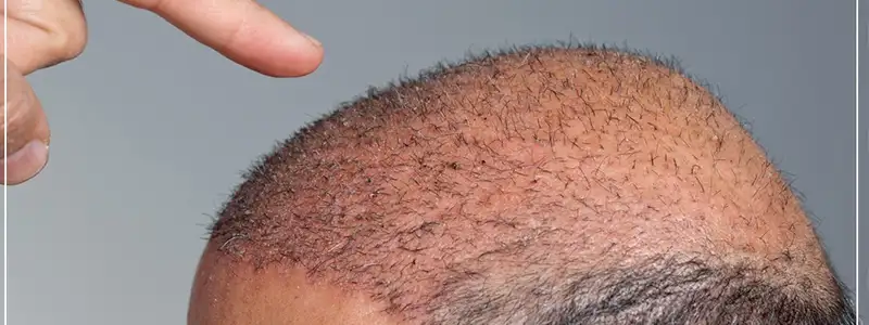 حقائق حول زراعة الشعر بدون جراحة
