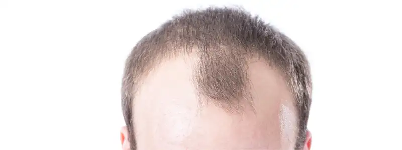 زراعة الشعر باقتطاف البصيلة بتقنية الخلايا الجذعية بدبى