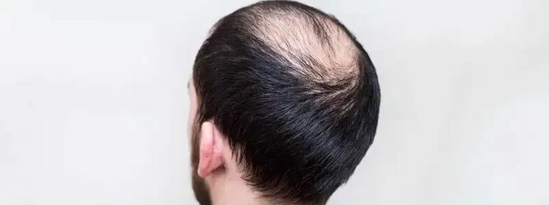 ثلاثة علاج تساقط الشعر الفعالة في دبي للثعلبة الجر