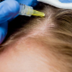 الميزوثيرابي العلاج الغير جراحي لإستعادة الشعر الطبيعي