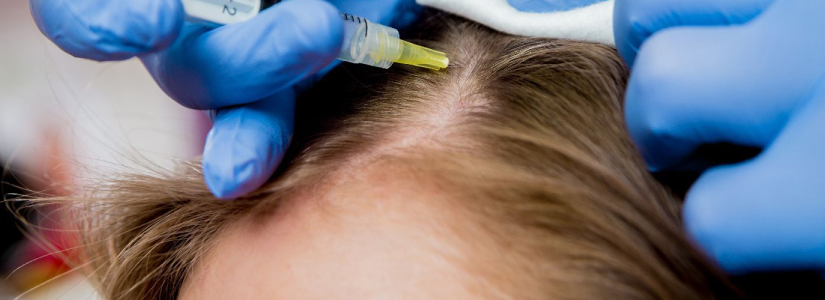 الميزوثيرابي العلاج الغير جراحي لإستعادة الشعر الطبيعي