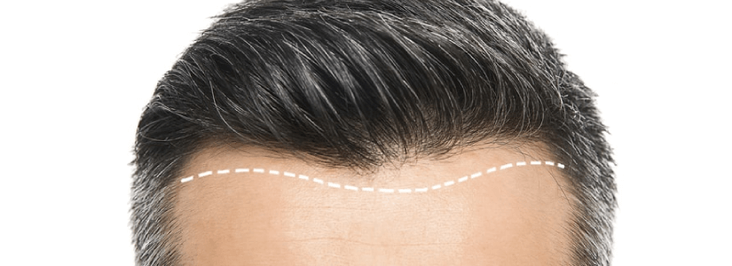How Many Grafts Do I need for a Good looking Hair Transplant